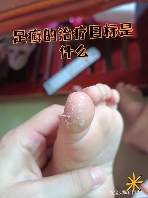【山东潍坊高密足不出户区重症详情_高密市足疗】
