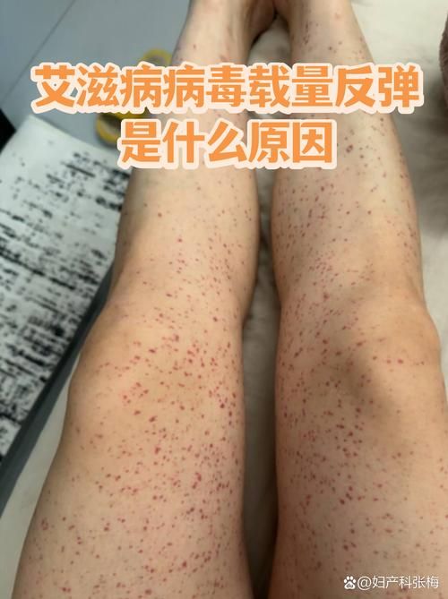 【全球疫情存反弹风险,全球疫情凶猛反弹】