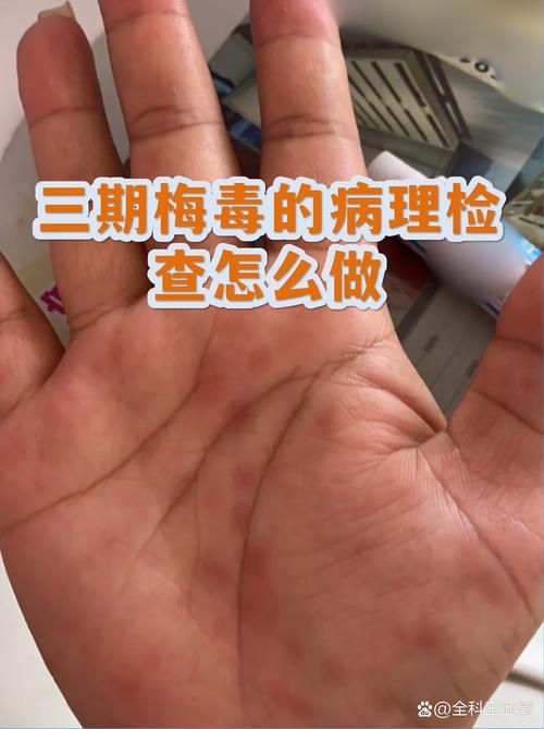 广东梅州梅县区首例死亡病例来源公布(梅州感染梅毒病例)