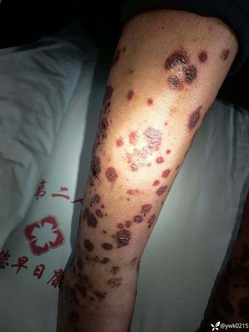 辽宁盘锦无症状感染者已蔓延11地:盘锦疑似病例